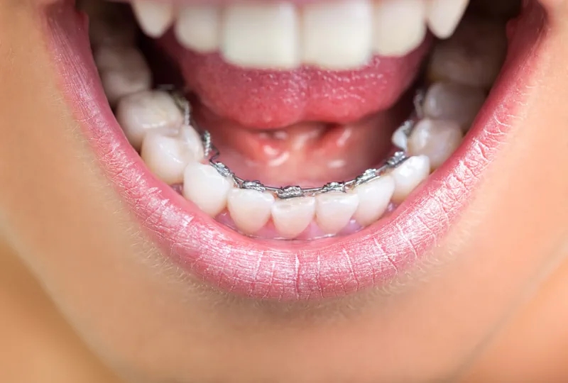 Instalación de Brackets con Ortodoncia Lingual en Valdivia