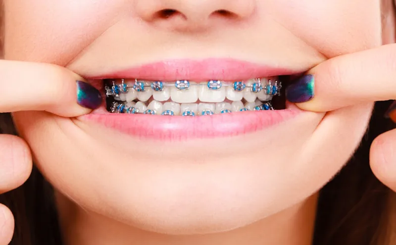 Contacta a expertos en la Instalación de Brackets