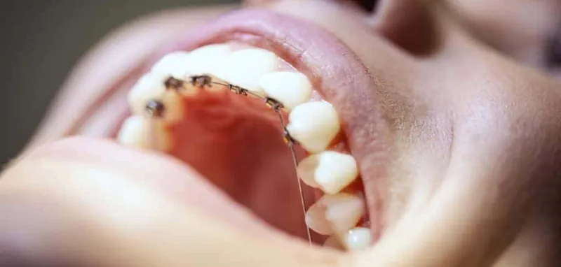 Instalación de Brackets con Ortodoncia Lingual en Valdivia