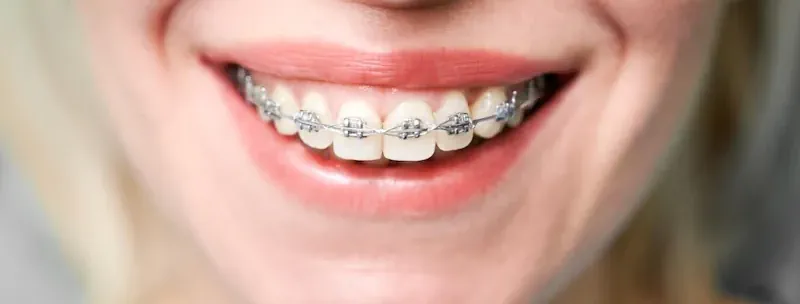 Valor del Precio de la Instalación de Frenillos o Brackets en Valdivia